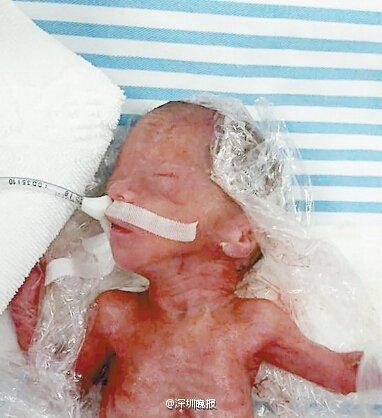 深圳孕24周仅500克超早产儿奇迹存活出院