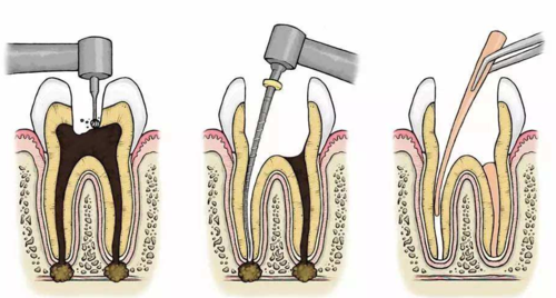 根管治疗术的费用