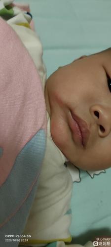 五个月的宝宝有口水疹怎么办?口水太多了.