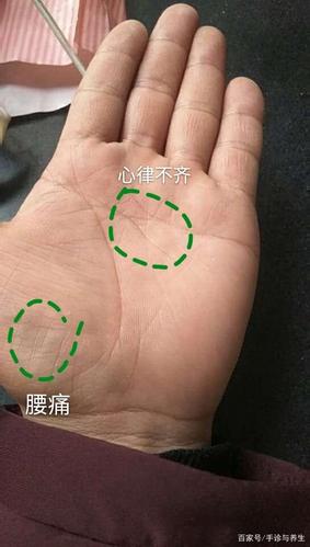 智慧线和感情线之间有明显的"贯桥线",提示的是冠心病,心脏功能异常的