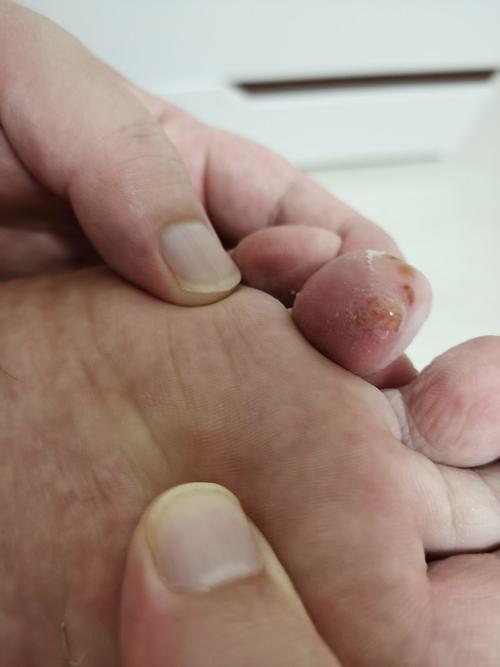 脚趾上长水泡,不痛不痒-男-40岁