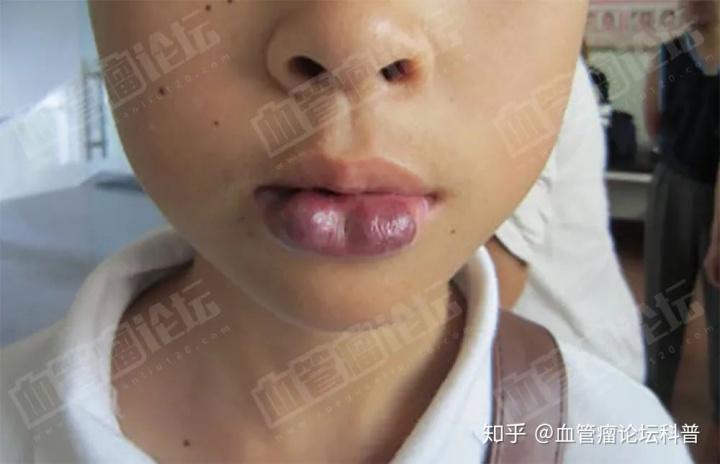 唇部血管瘤有这些症状