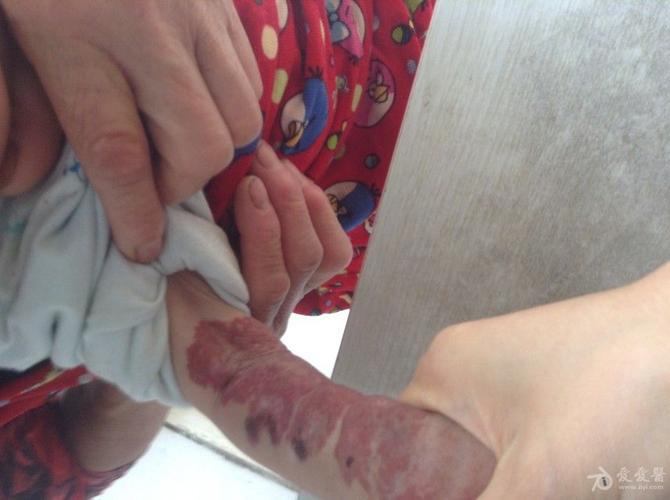 罕见先天性疾病(图片)