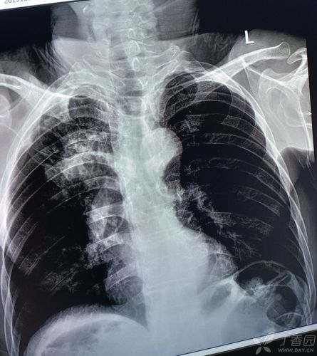 病人胸片,请大家我没有肺结核或肺癌等其他情况