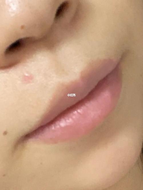 点痣水留下的增生修复之路_点痣_疤痕_开眼角_祛疤_美