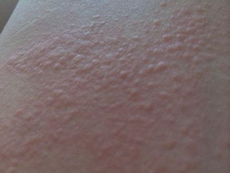 荨麻疹吗?_百度知道