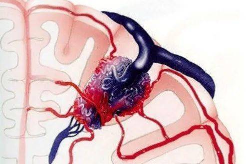 引发脑出血的这一元凶,你知道吗?--- 脑动静脉畸形(bavm)