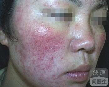 早期过敏性皮炎的典型症状是什么?