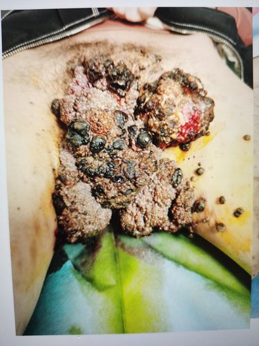 男性巨大尖锐湿疣