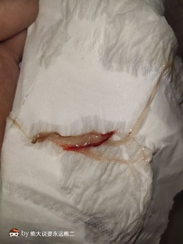 排卵期第11天,这是着床出血吗,有知道的吗