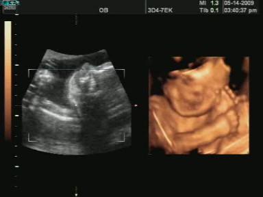 5月14日怀孕24周,去医院做了四维b超,买了光盘,有肚子里面宝宝的