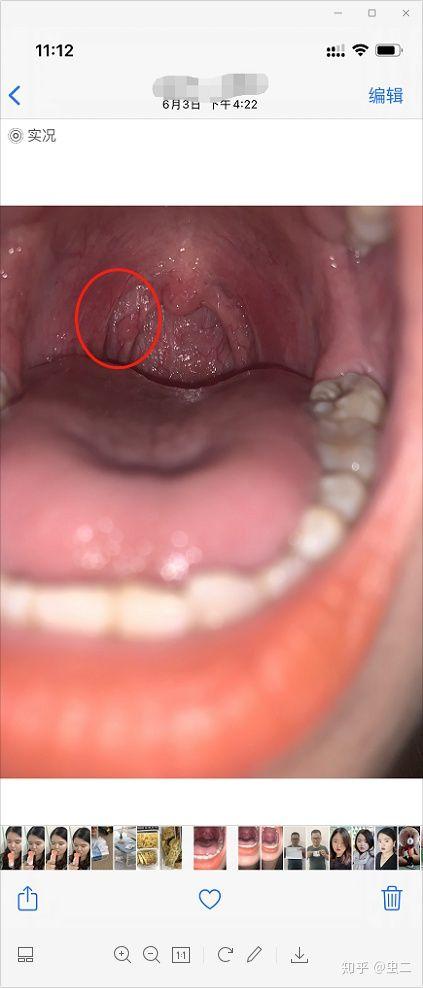 咽喉囊肿or乳头状瘤手术切除过程