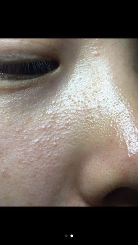 鼻子两边的皮肤长了许多小颗粒,凹凸不平,是白头还是脂肪粒