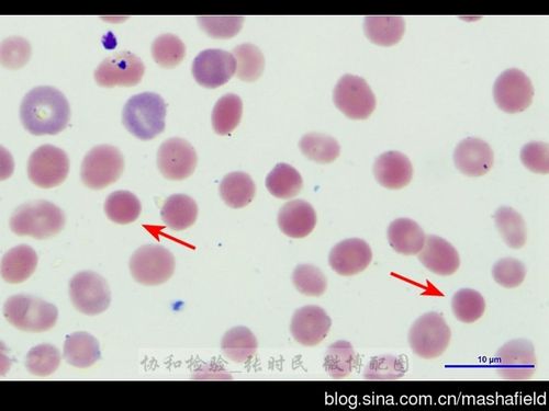 遗传性球形红细胞增多症一例