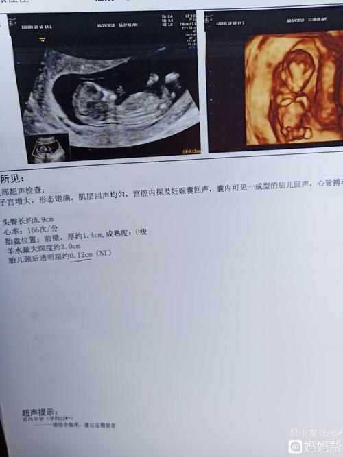 今天做了nt一切正常 希望我的鼠宝宝健