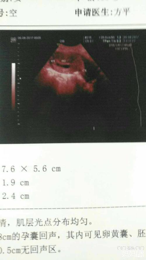 看看这43天的孕囊,啥形状的啊?亲亲们