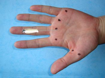 屈指肌腱鞘炎治疗