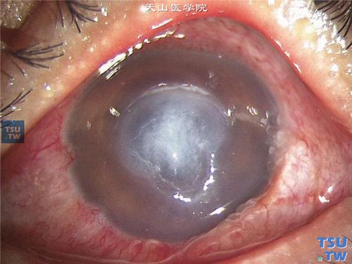 细菌性角膜炎(最详症状图解)