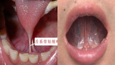 舌系带短手术几天能好