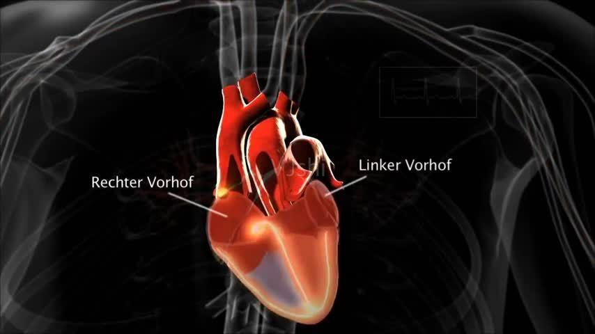 人体心脏跳动机理动画心房颤动