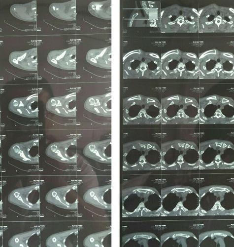 (肩锁关节 胸锁关节)ct平扫