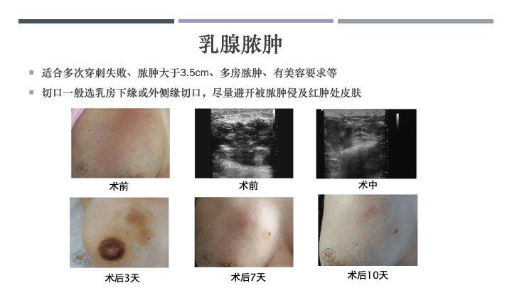 乳腺微创手术到底怎么做?