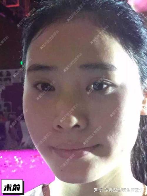 为什么下巴跟嘴巴这一块往里凹这是瘪嘴嘛而且嘴角还有皱纹求解