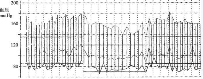 图21-2动态血压曲线