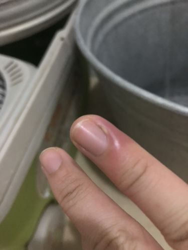 不痒,不是蚊虫叮咬也不是烫伤,但一碰就痛,这是怎么回事指甲边的肉还