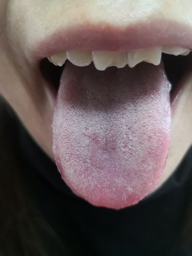 从你的舌苔来看,就是脾虚湿重的.然后就是血虚.