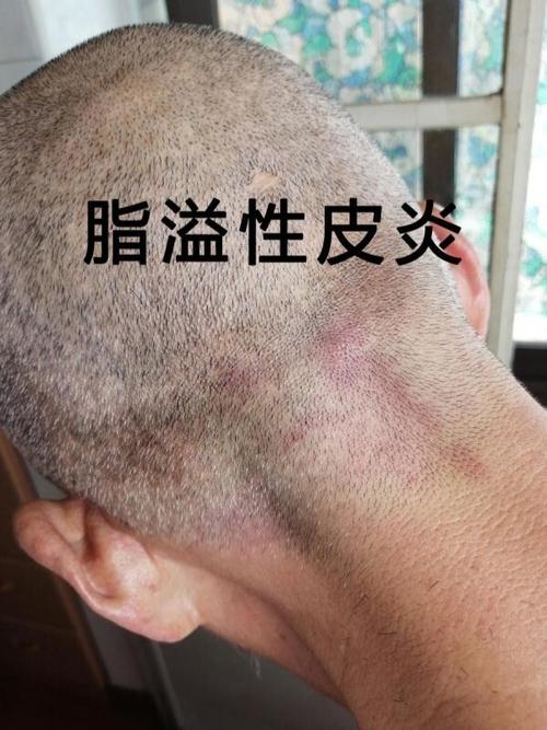 脂溢性皮炎不一定什么时候就找上了你 你以为头皮屑太多只是因为发质