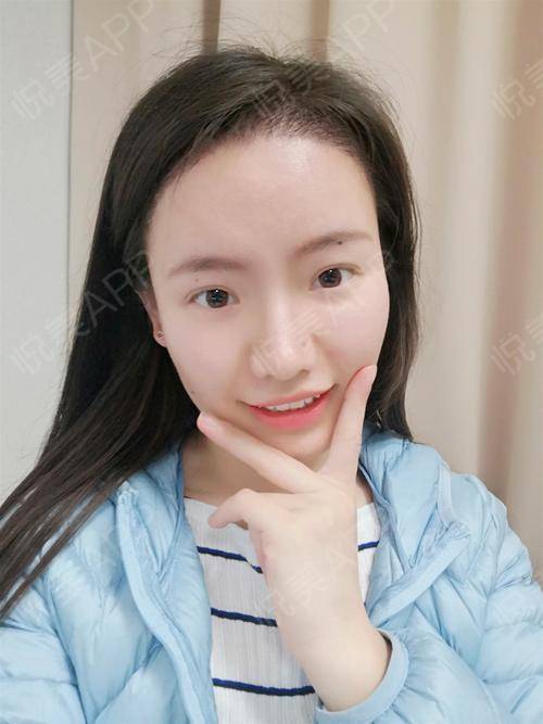 美人尖种植术后15天_发际线种植术后15天_头发种植术后15天_头部毛发