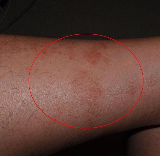 正文   湿疹感染是由各种潜在的病毒,细菌或真菌引起的.