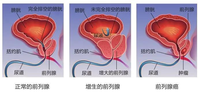 同时前列腺钙化可以完全没有症状,也可能会是慢性前列腺炎反复发作的