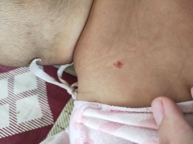 一开始一直以为是红痣后来才发现是血管瘤这是毛细血管瘤吗