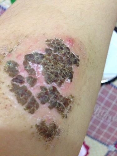 请问如何防止留疤阿 血痂有几天了 今天不小心碰掉了