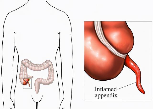 阑尾炎是被人所熟知的疾病都可用手术切除那么它有哪些危害呢