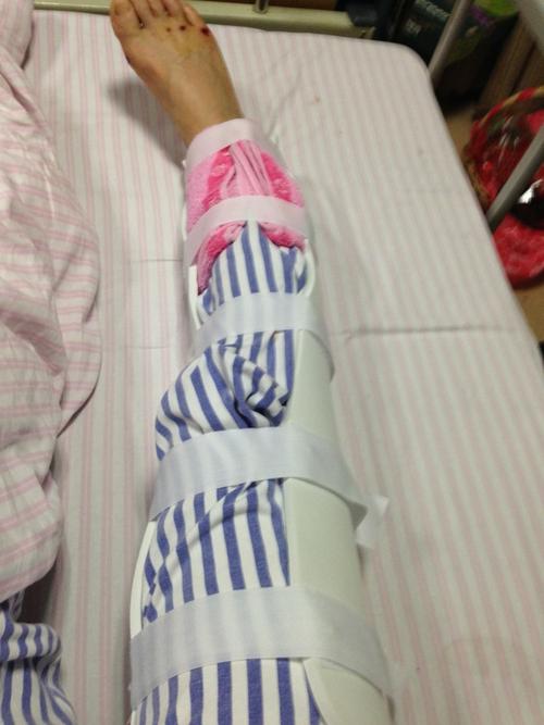 小腿骨折石膏固定治疗