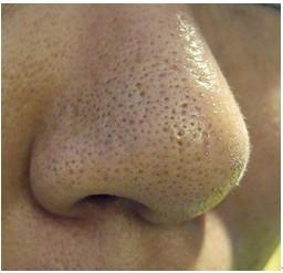 亲,还在挤黑头吗?