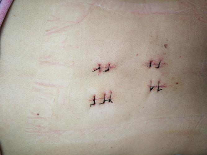 热烈祝贺我院骨二科开展经皮椎弓根内固定治疗胸腰椎压缩性骨折手术