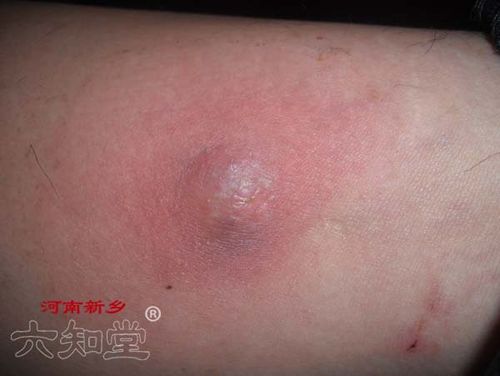 身上有个疮怎么办 河南哪里治疗疮好 新乡六知堂治疗毒