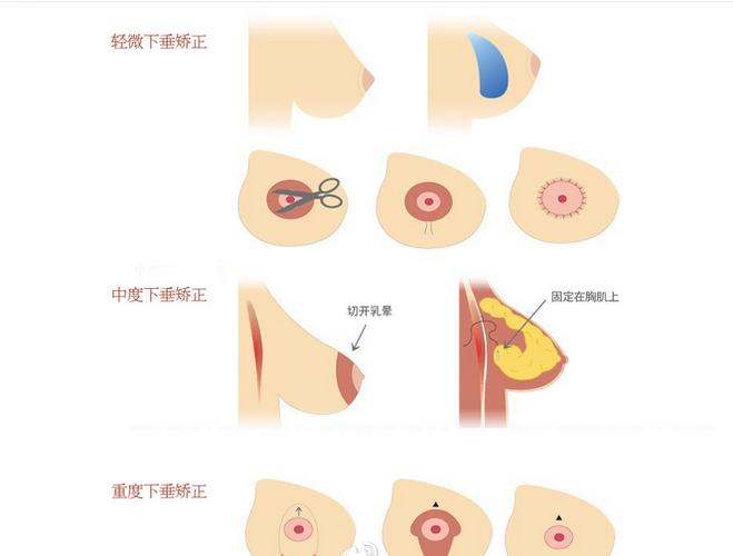乳房下垂严重怎么办-重庆当代整形美容医院