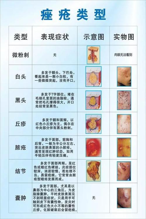 2,丘疹型:痤疮的炎症继续发展扩大深入后,出现炎症丘疹和丘疹中间有