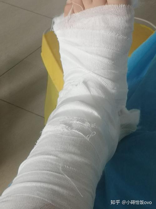 骨折记录 - 知乎