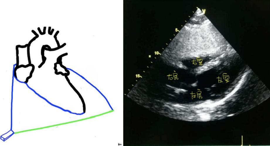 图文详解 | 心超切面不会打?看这一篇就够了!_心尖