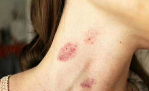 脖子上"种草莓"到底好不好?