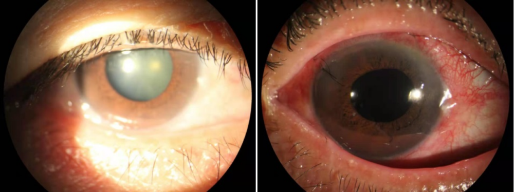 眼睛突发胀痛需重视,可能是青光眼和白内障找上门了