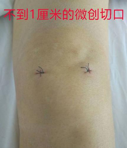 深圳关节镜修复膝关节半月板损伤|手术|微创_网易订阅