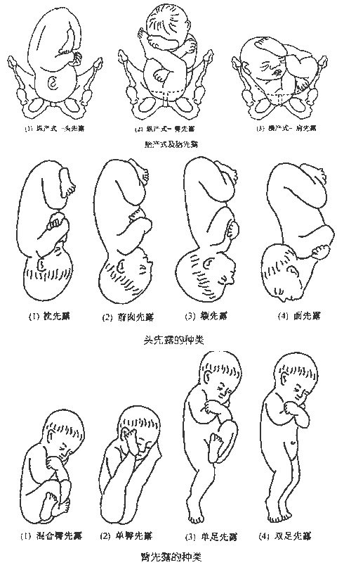 胎位不正别担心,应对方法都在这!