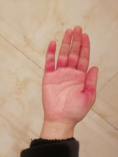 手上这几天长红斑了,又痛又痒的,泡热水还挺痛,有人知道咋回事吗